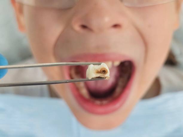 Best Emergency Dentist for Special Needs Patients in Casselton, ND